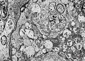 M,13y. | ganglioglioma